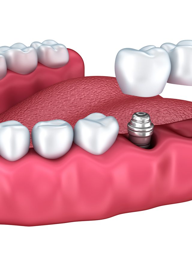 The Freedom of Dental Implants
