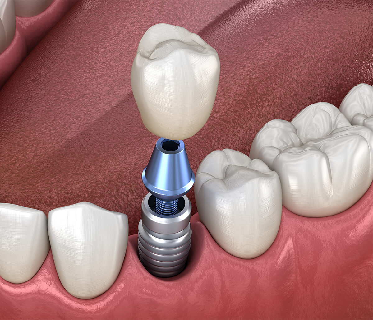 Dental Implants in Half Moon Bay Area