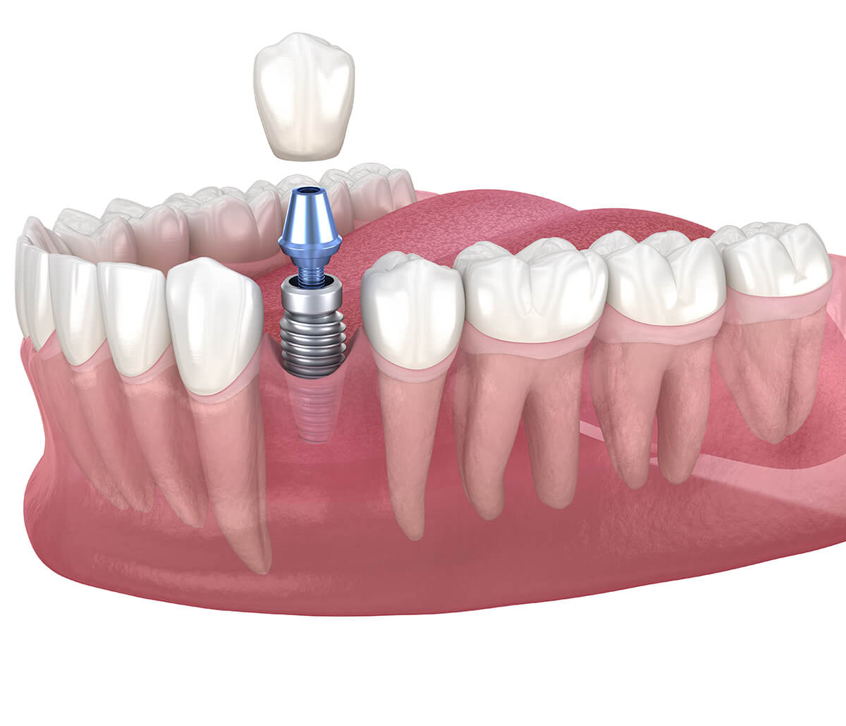 Dental Implants in Pacificahalf Moon Bay Area