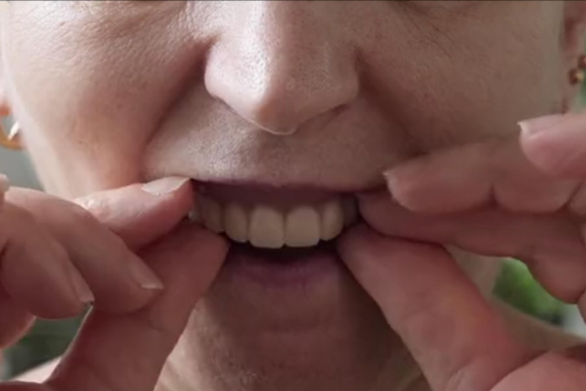 Transform your smiles, all-on-four implant solution!