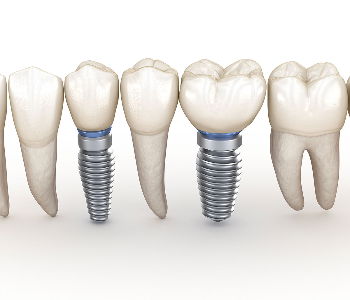 Affordable Dental Implant Services In Dublin area
