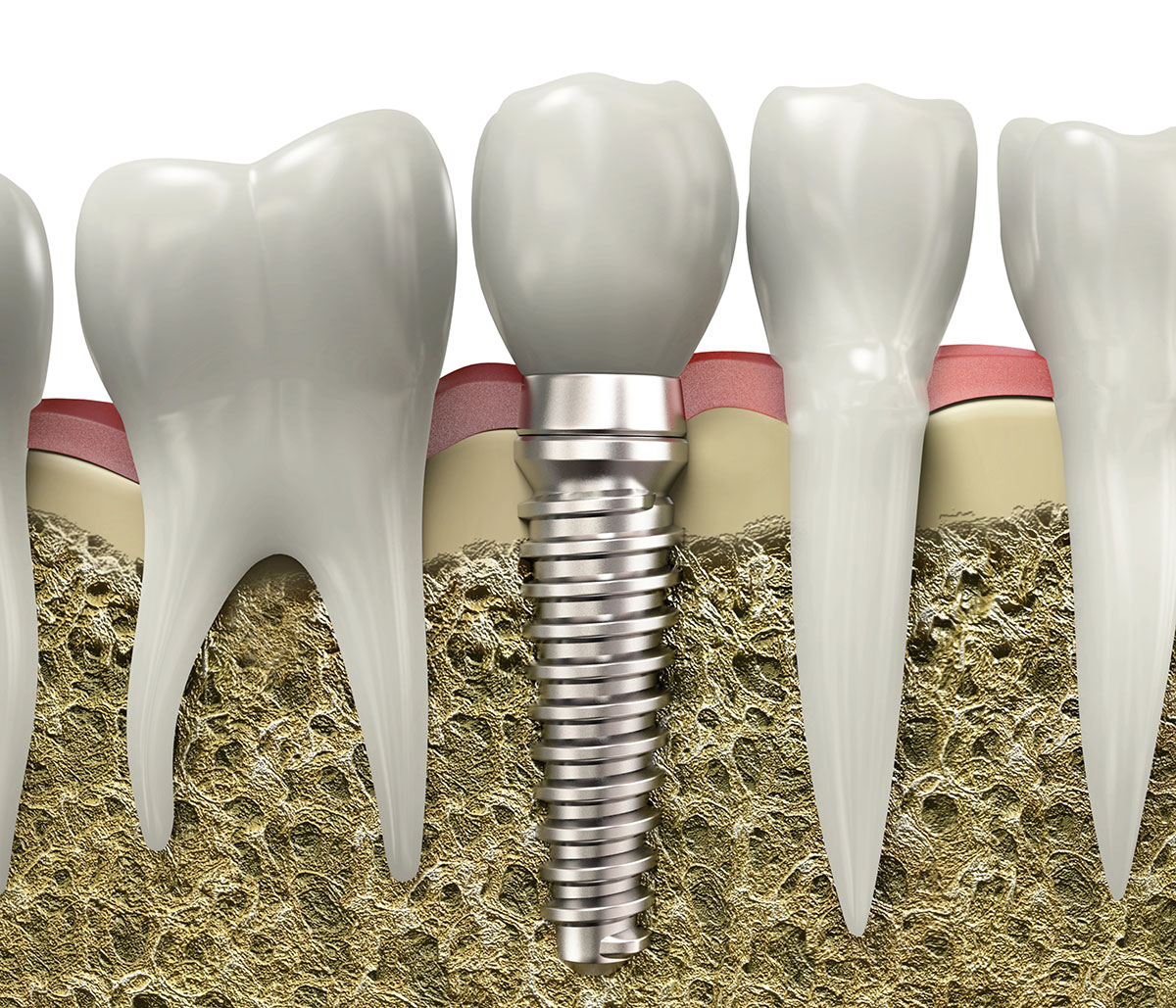 Affordable Dental Implants Clinic in San Leandro CA area