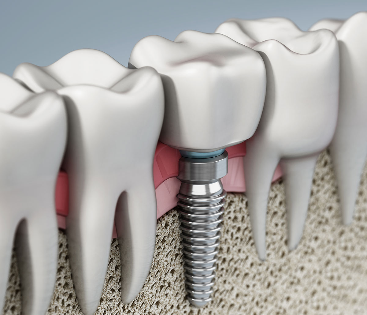 Are Dental Implants Worth the Cost in Castro Valley area