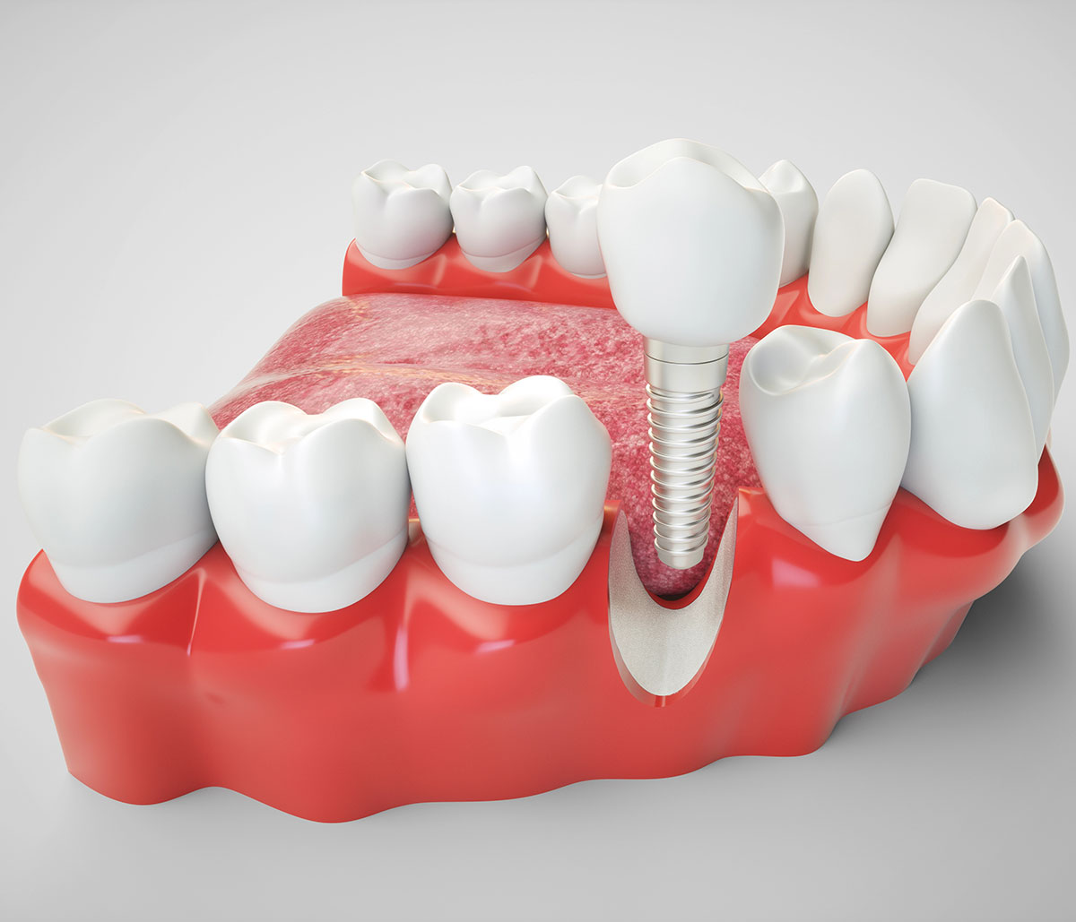 Cost of Dental Implants in San Ramon CA Area