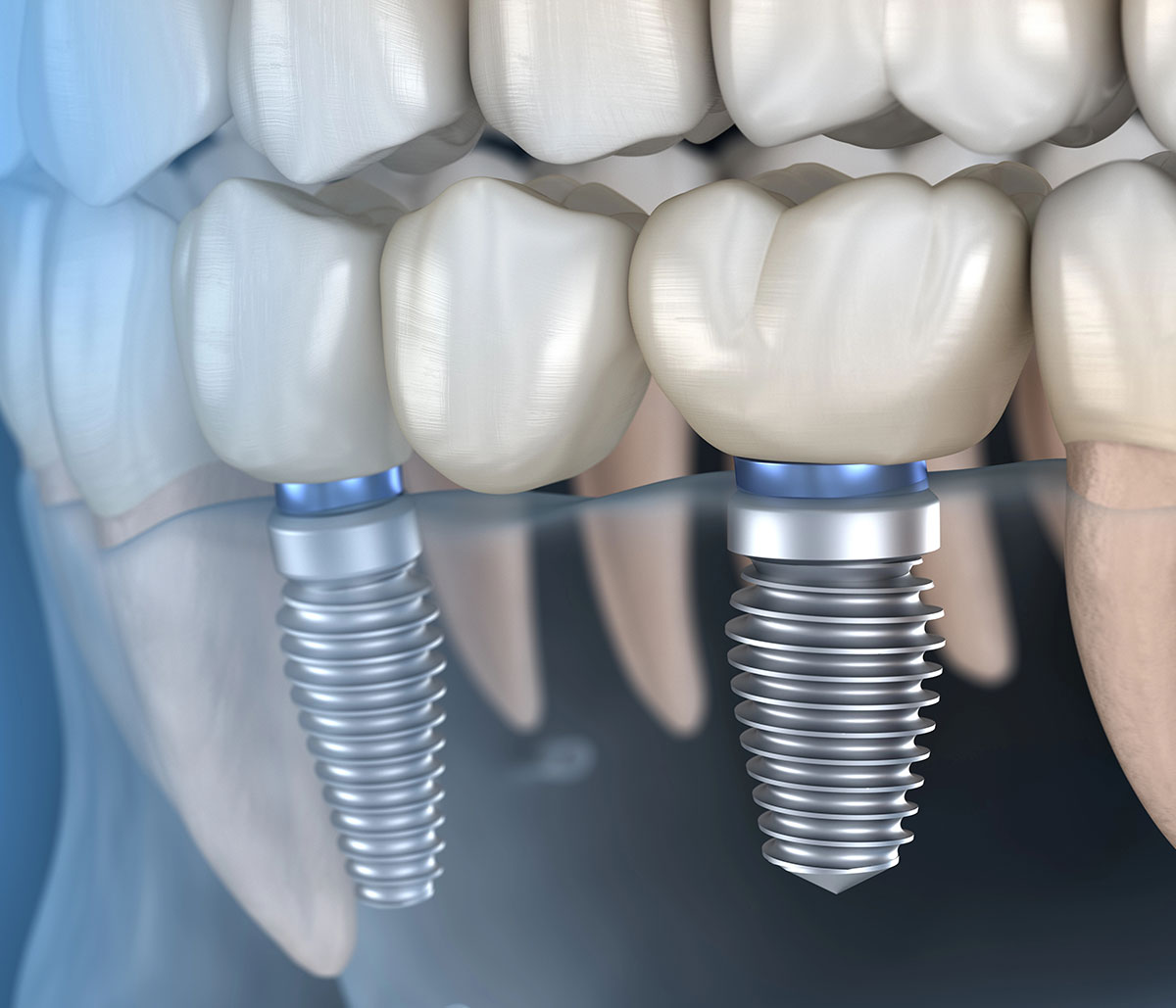 Dental Implant Costs in Near Milpitas area