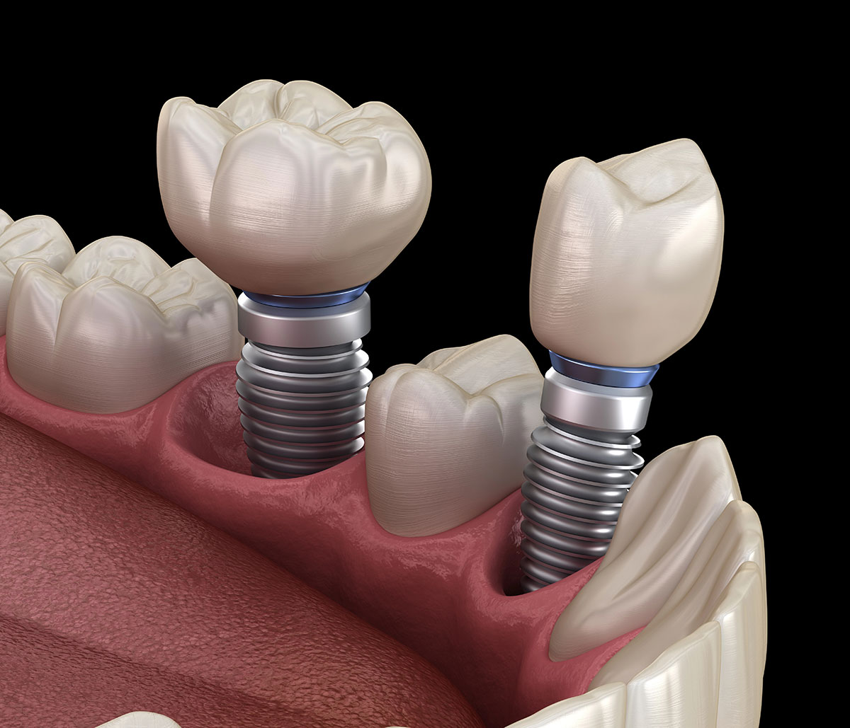 Dental Implant Specialists Near in Fremont area