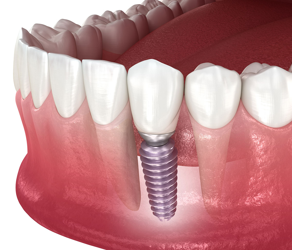 Dental Implants Cost Without Insurance in Pleasanton area