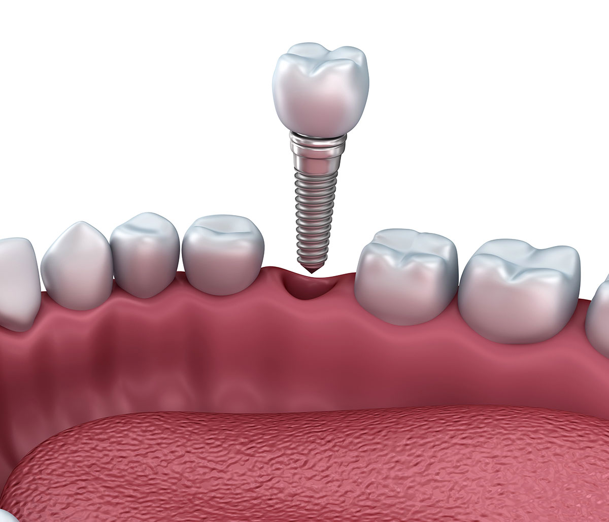 Dental Implants Covered by Insurance in Berkeley area