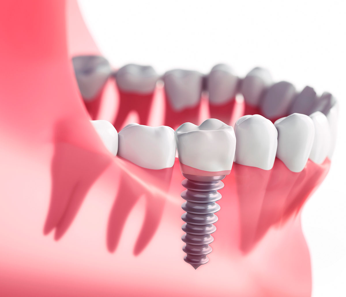 Dental Implants vs. Dentures in Cost Livermore area