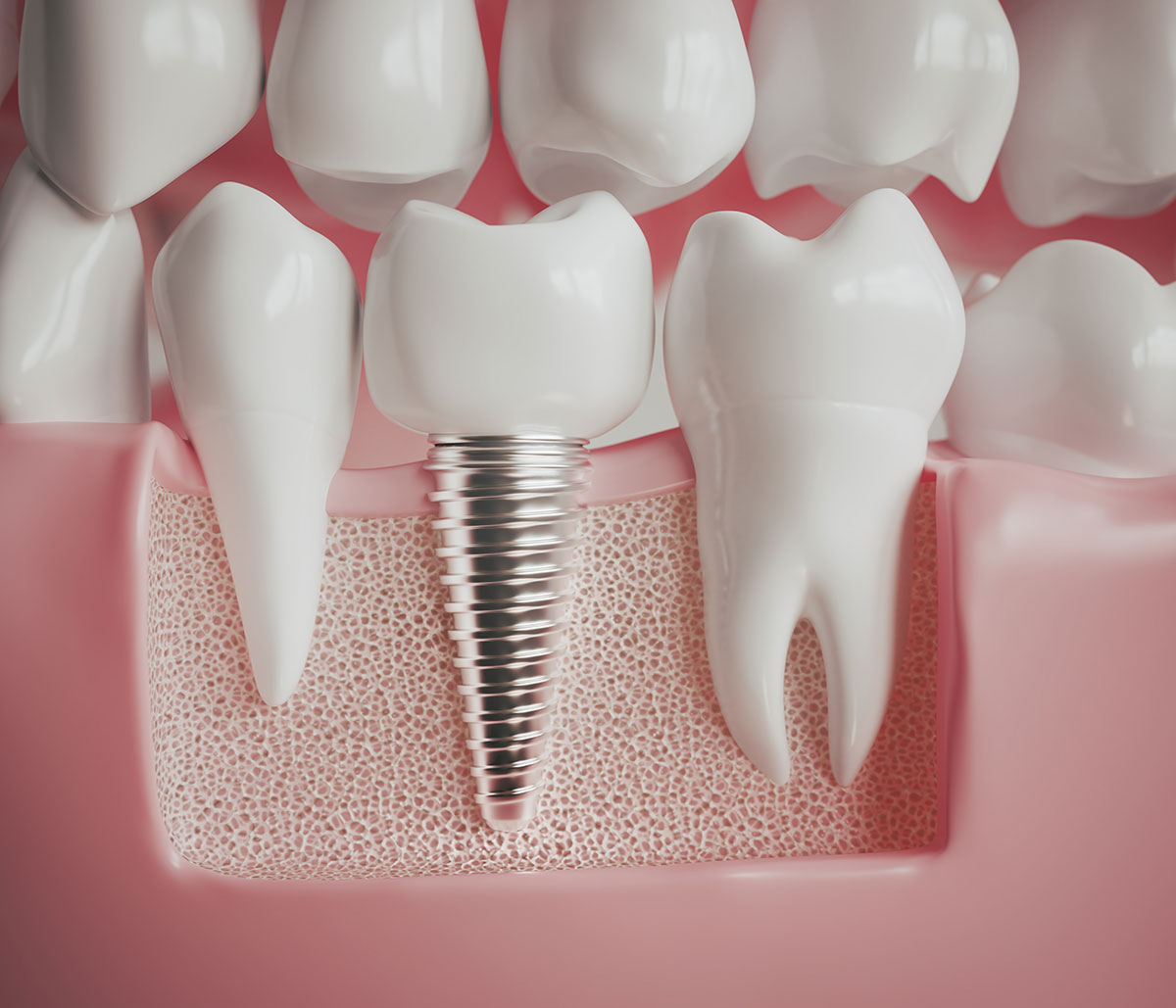 Low-Cost Dental Implants Near in Union City area