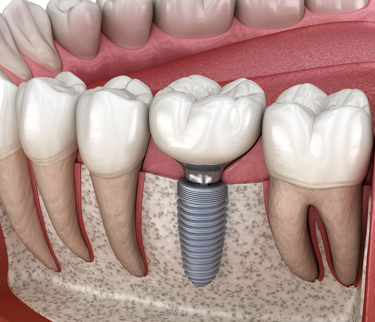 Single Tooth Implant Cost in San Rafael Area
