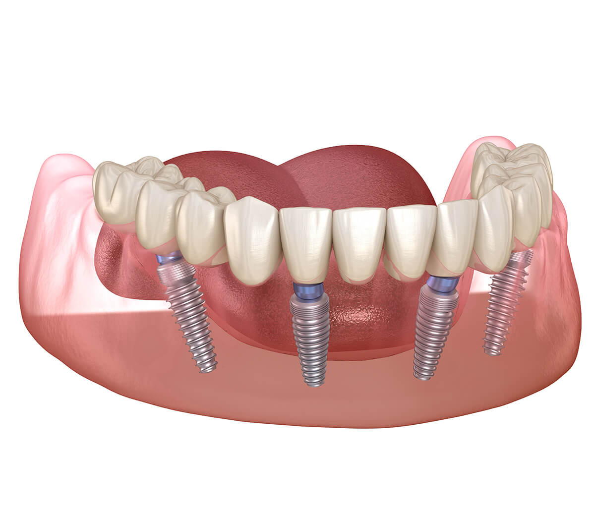 All-on-4 Implants FAQs in San Carlos CA Area