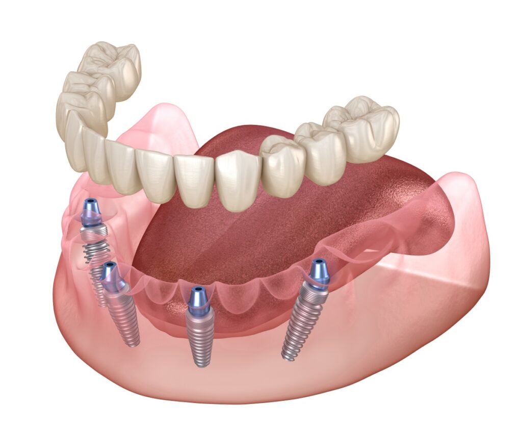 ceramic dental implant treatment near you