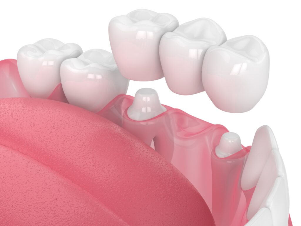 dental bridge and crown treatment near me