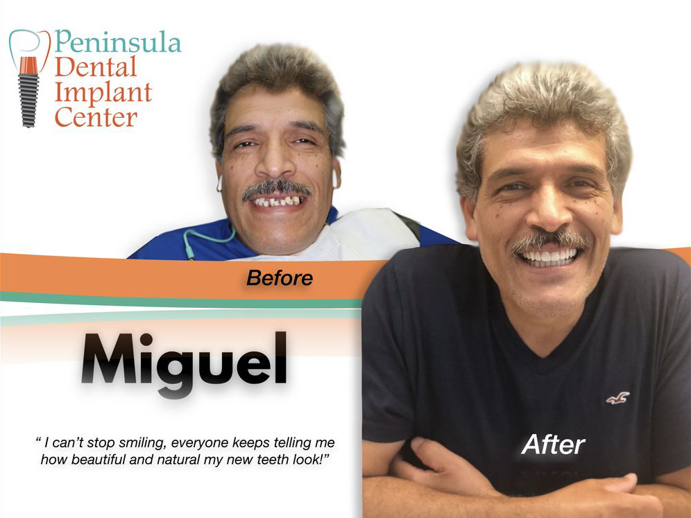 Before and After image of Dental Implants in Half Moon Bay Area