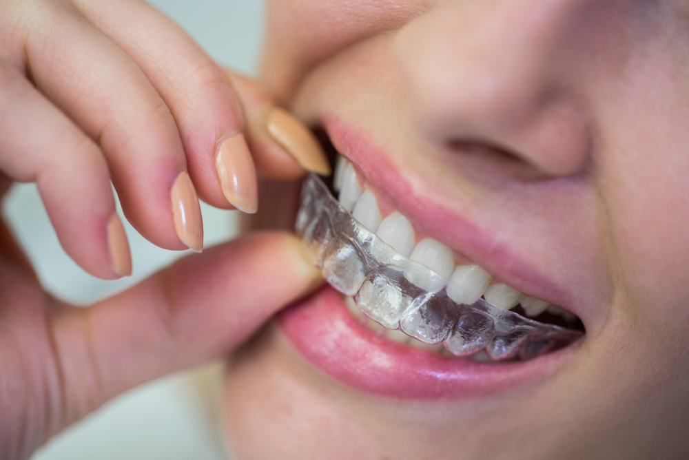 Achieve the smile you’ve always wanted with Invisalign in Redwood City. Clear aligners offer comfort, convenience, and lasting results
