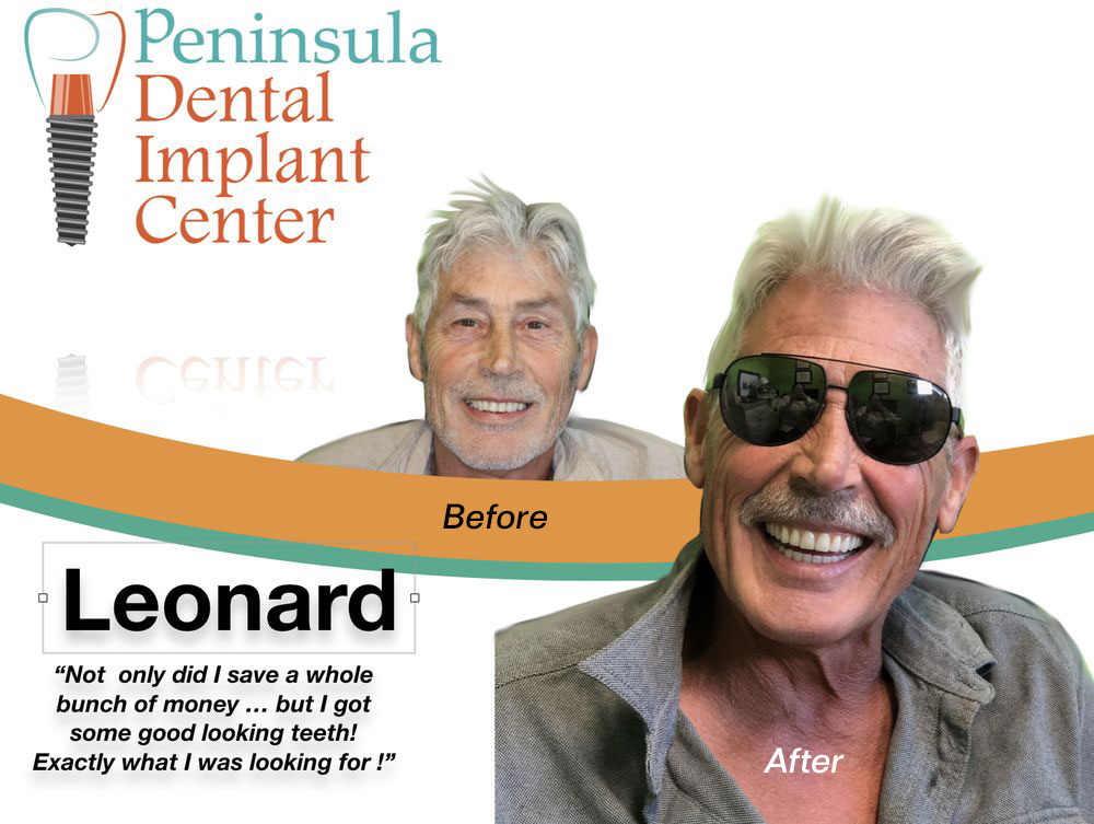 Before & After image of All-on-Four Implants in Redwood City CA Area
