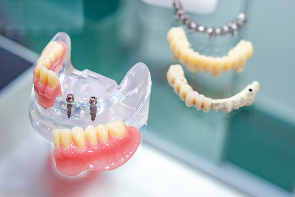 mini dental implants what they are and when they re used