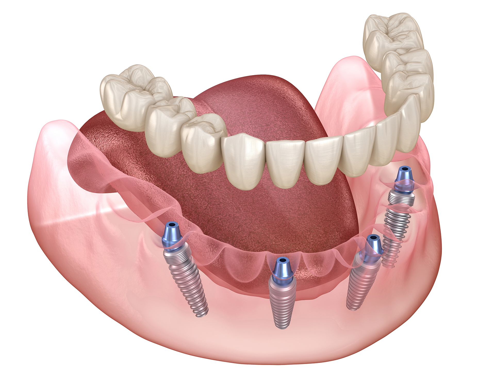 all on x bridge materials compared titanium acrylic monolithic zirconia and zirconia crowns over a thimble bar